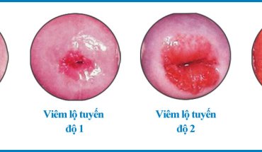 PHÁT HIỆN LỘ TUYẾN CỔ TỬ CUNG: CÓ NHẤT THIẾT PHẢI ĐỐT?